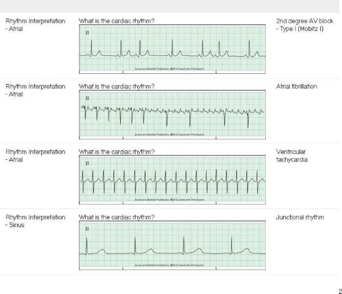 Relias dysrhythmia basic a test answers