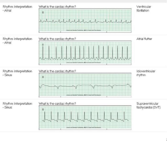 Relias dysrhythmia basic a test answers